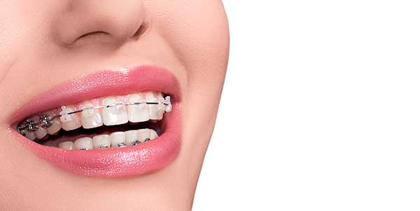 Clear Braces | Wellesley MA Orthodontist